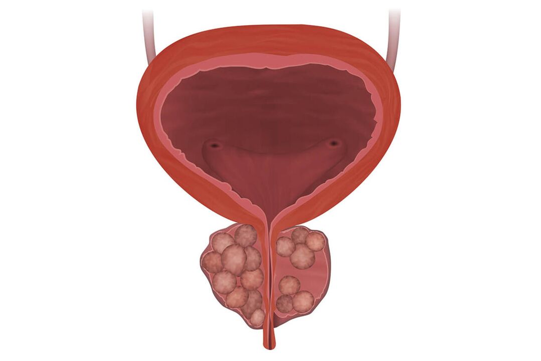 Symptômes de la prostatite